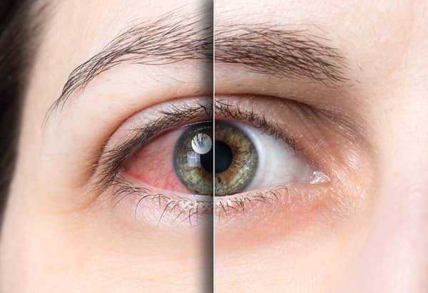 A patient eyes comparison after undergoing dry eye treatment