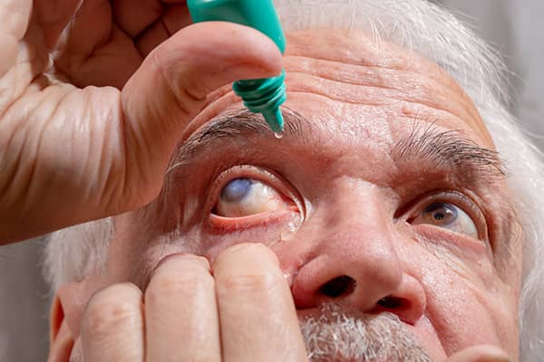 An old man applies prescription eye drops to one of his eyes to treat glaucoma