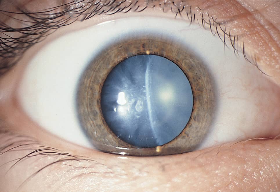 Frontal view of a patient showing cataracts on his eyes