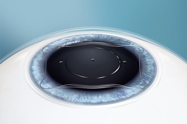 EVO Visian Implantable Collamer lenses implanted in the cornea area