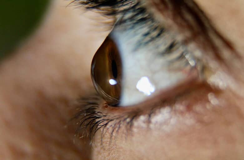 Lateral view of a patient with a keratoconic cornea