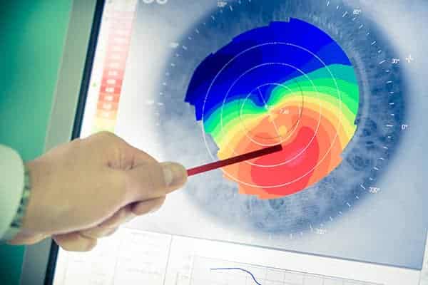 How long does corneal surgery take to complete