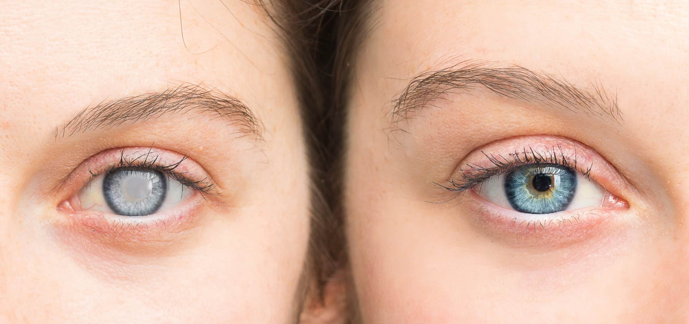 14 Reasons Why Cataract Surgeries Need Additional Treatments