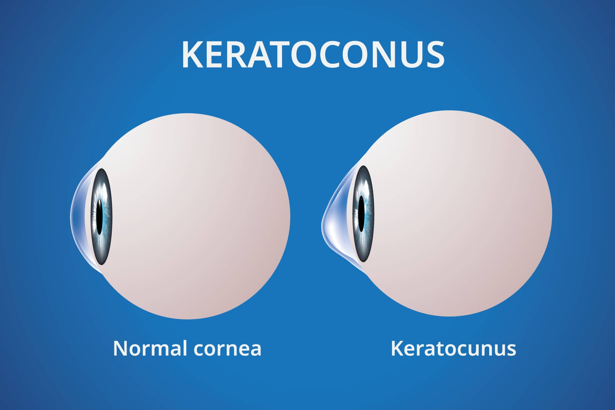 Early detection and treatment can help slow the progression of Keratoconus and improve your quality of life