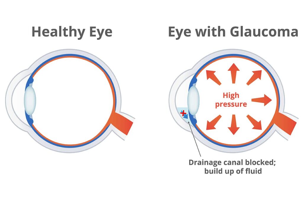 People living with diabetes have an elevated risk of developing glaucoma, a condition caused by an accumulation of fluid in the eye that harms the tissues crucial for vision.