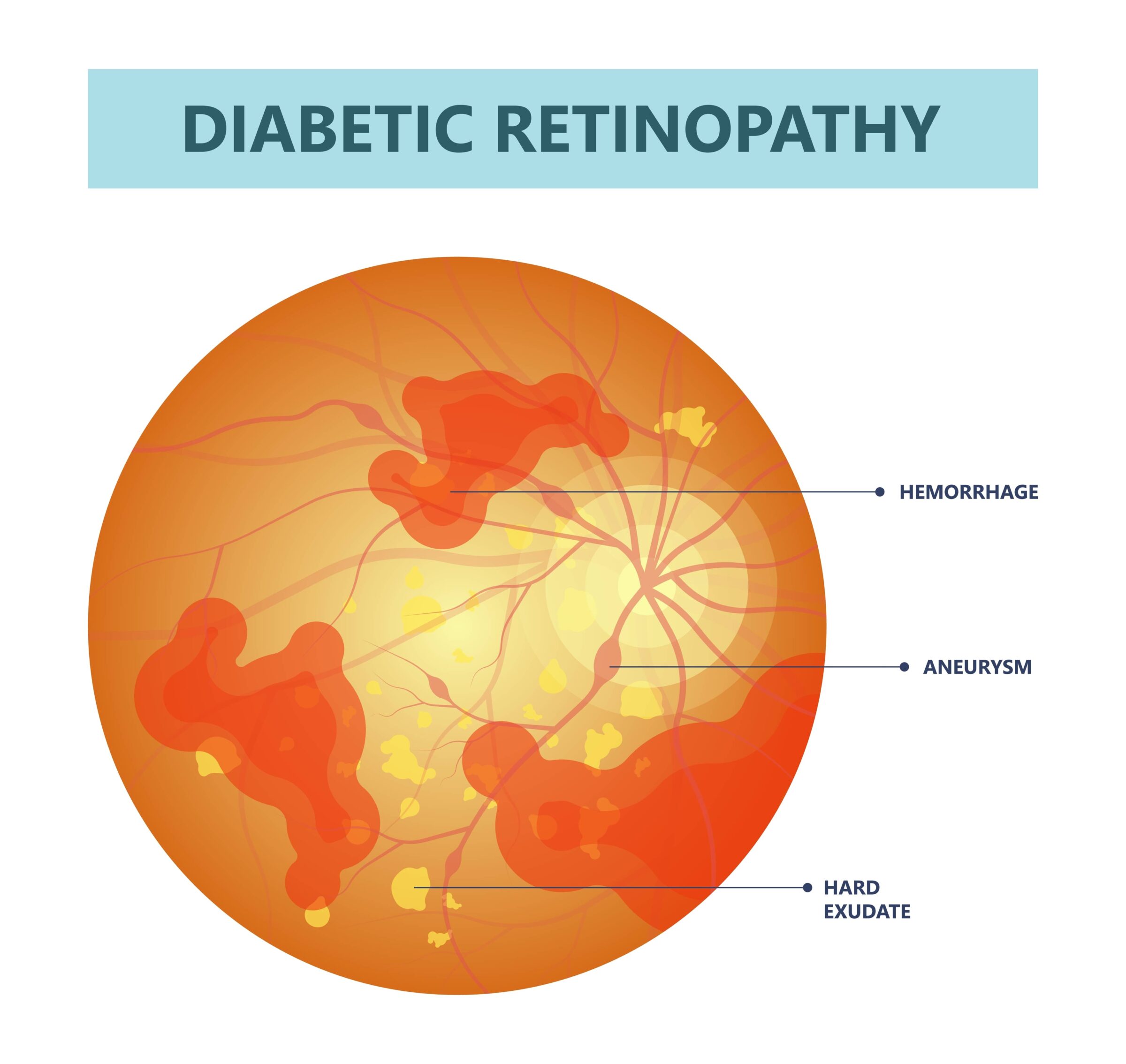 Diabetes can cause damage to the blood vessels of the retina, known as diabetic retinopathy.