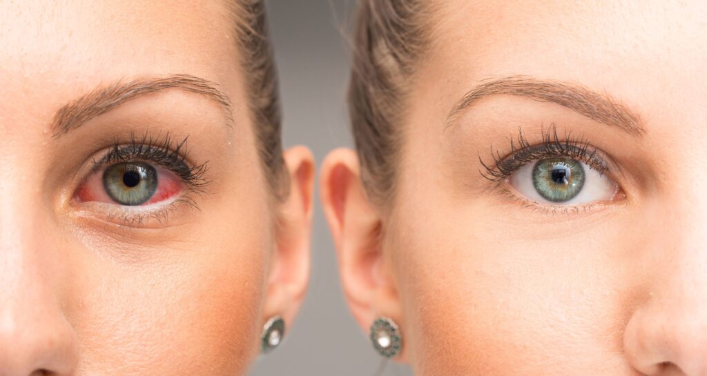 Dry eye can cause redness and irritation in the eyes